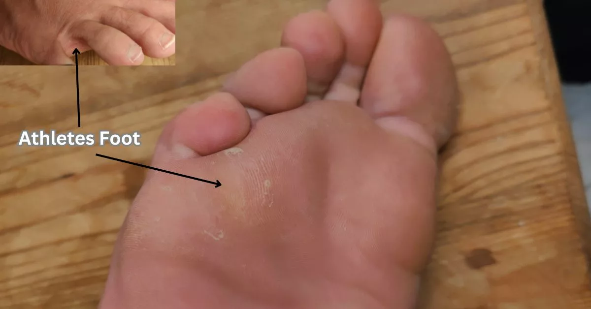 Athletes Foot Before using Lamisil Once